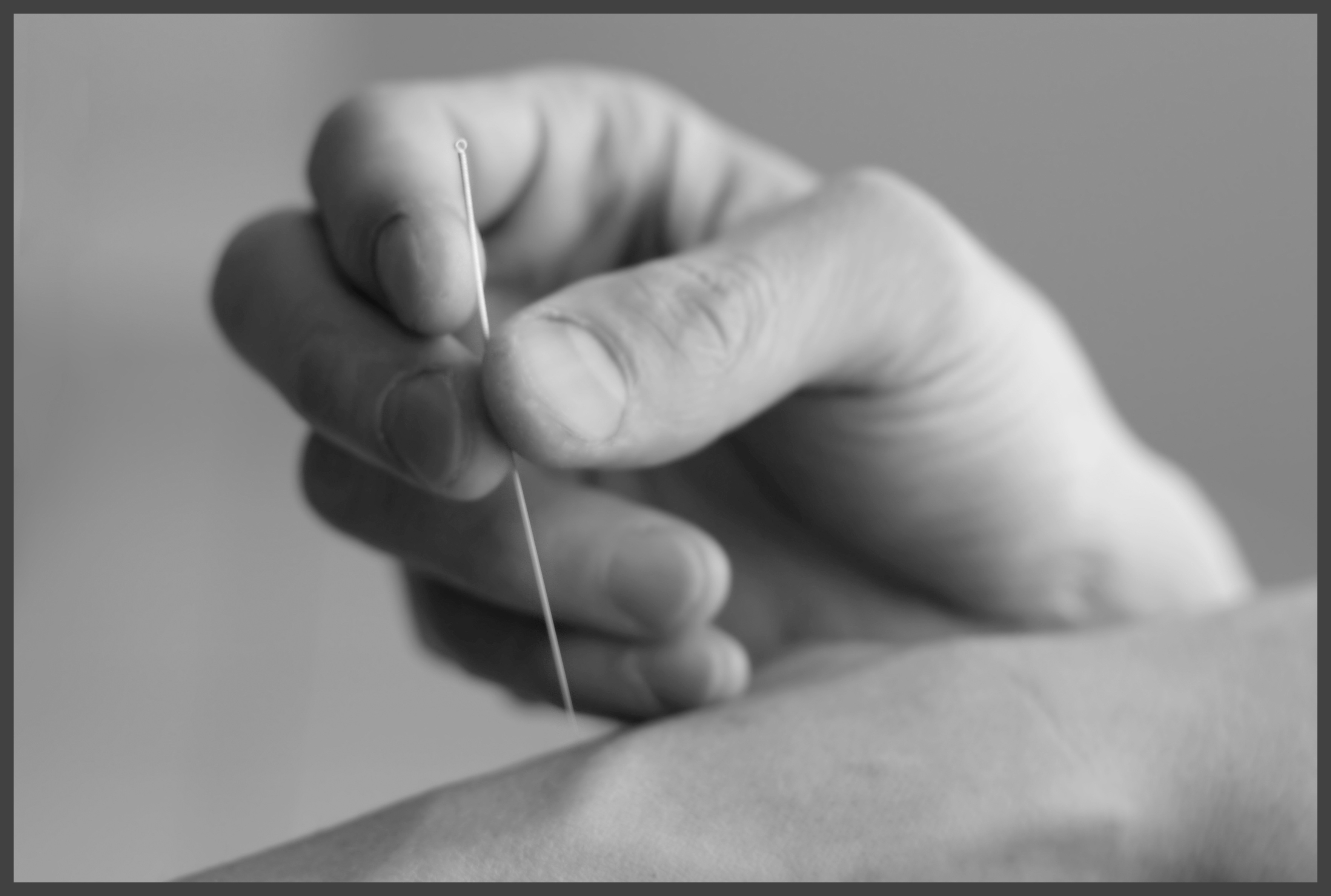 acupuncture bw2